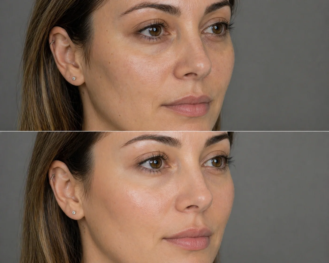 Filler Viso — Acido Ialuronico