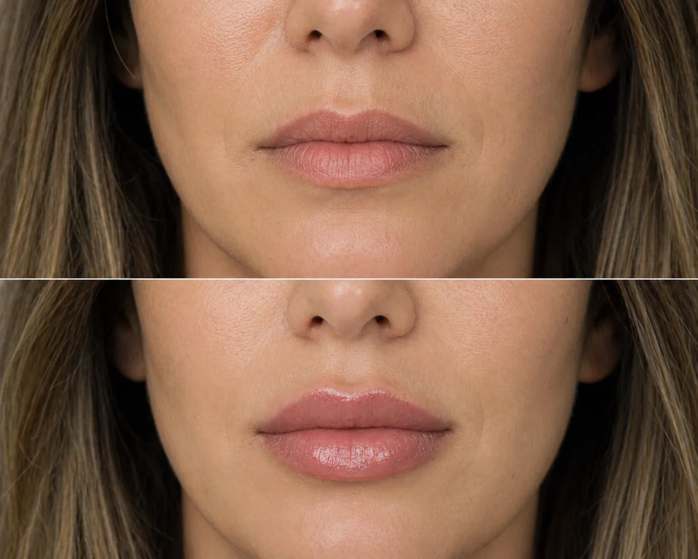 Filler Labbra